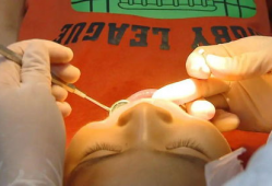 拔牙视频全过程,拔牙手术的惊心动魄瞬间